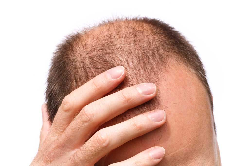 hair loss treatment