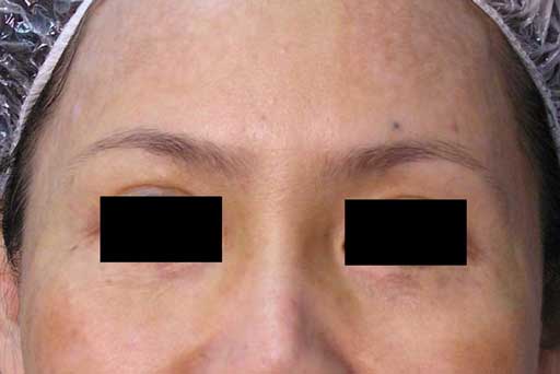 melasma treatment