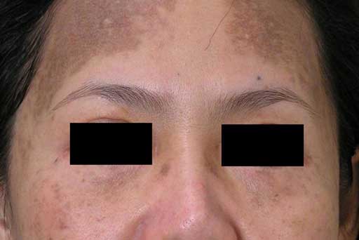 melasma treatment