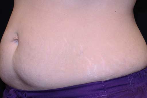 sagging skin treatment