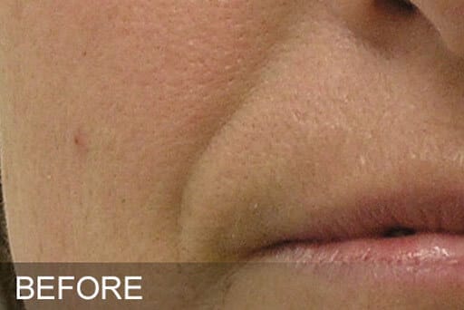 hydrafacial surrey