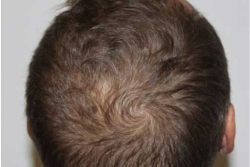 hydraFacial keravive