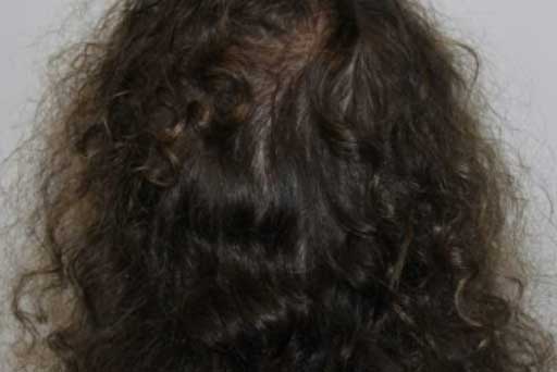 hydraFacial keravive