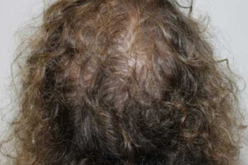 hydraFacial keravive