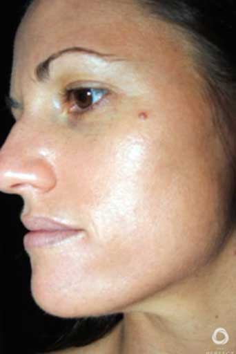 the perfect derma peel