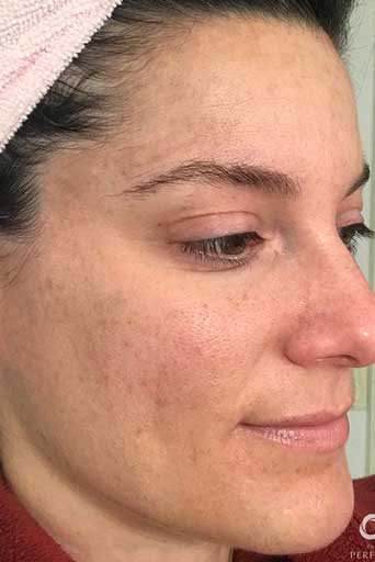 the perfect derma peel