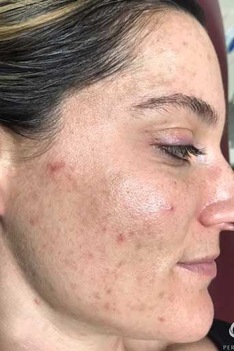 the perfect derma peel