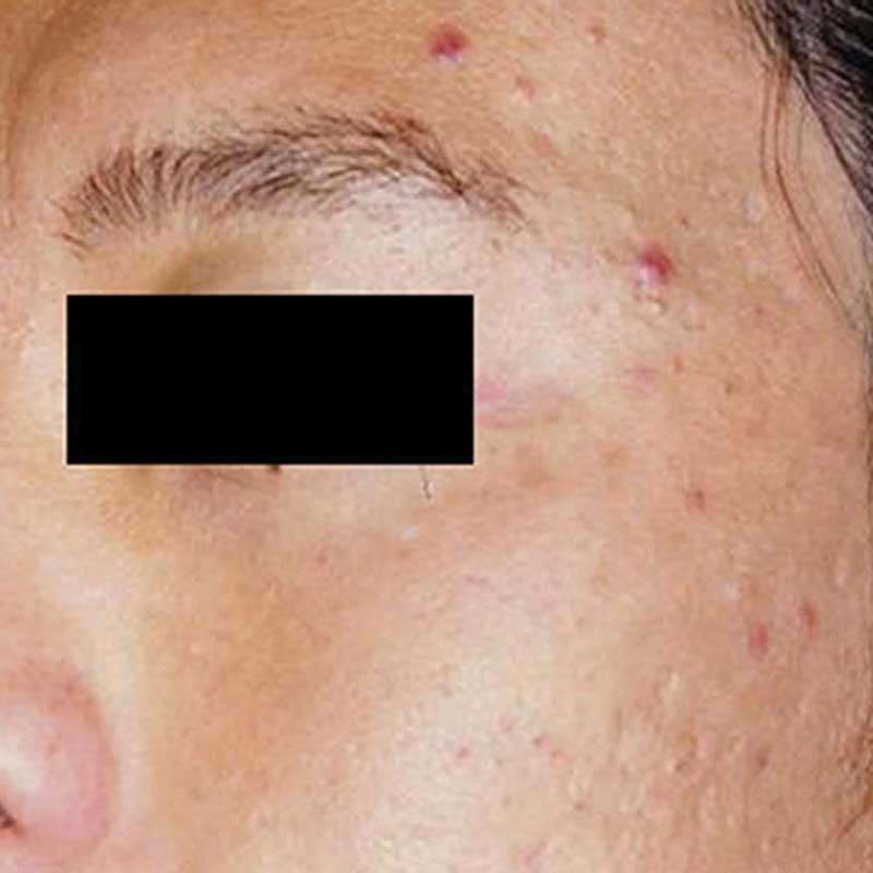 skin pigmentation treatment