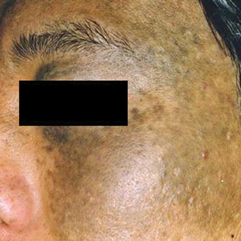 skin pigmentation treatment