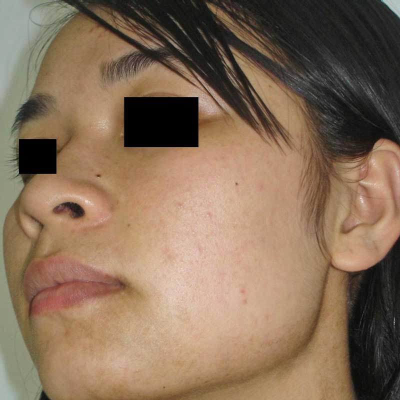 laser birthmark removal