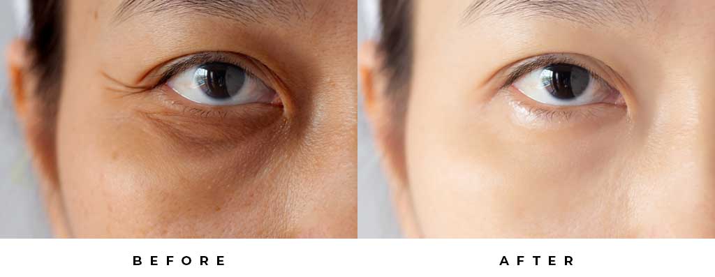 EndyMed Eye Treatment