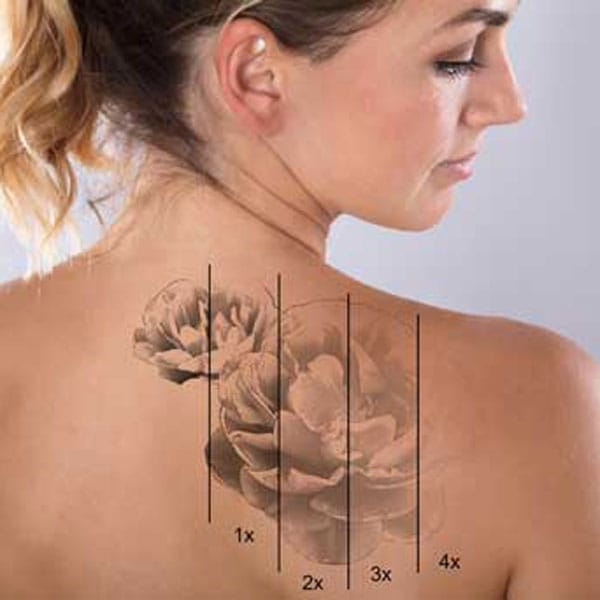 Laser Tattoo Removal