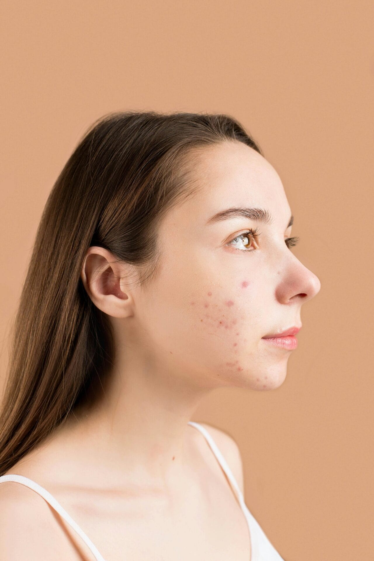 Acne Rx Facial